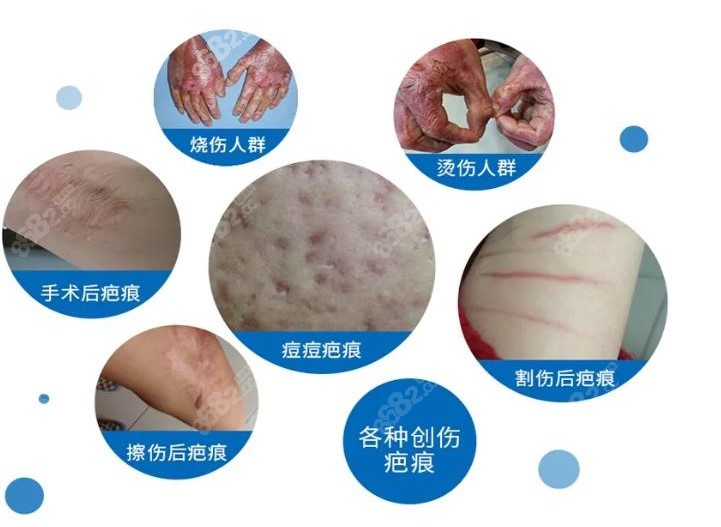 最新疤痕修復技術重塑肌膚之美，重塑肌膚的完美選擇