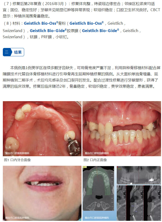 最新再生牙技術(shù)，笑迎人生，勇敢追求學(xué)習(xí)與變化的力量